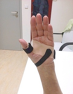 Rehabilitace ruky-revmatoidní artritida